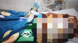 Korban Usai Menjalani Operasi Pembersihan Kulit Akibat Luka Bakar. (Rakyatmu)